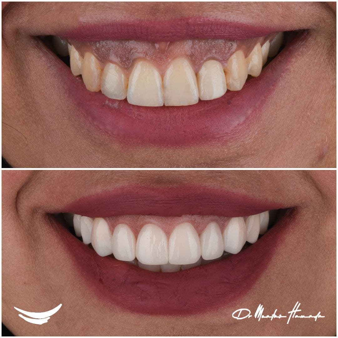Before and after cosmetic dentistry transformation 1